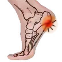 heel pain