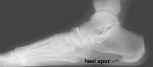 heel spur